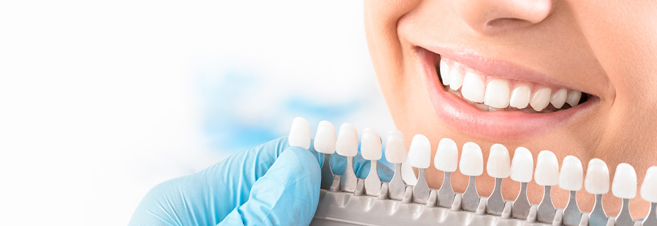 Eine Frau lächelt, vor ihrem Mund ist eine Farbpalette mit Zähnen verschiedener Weißgrade